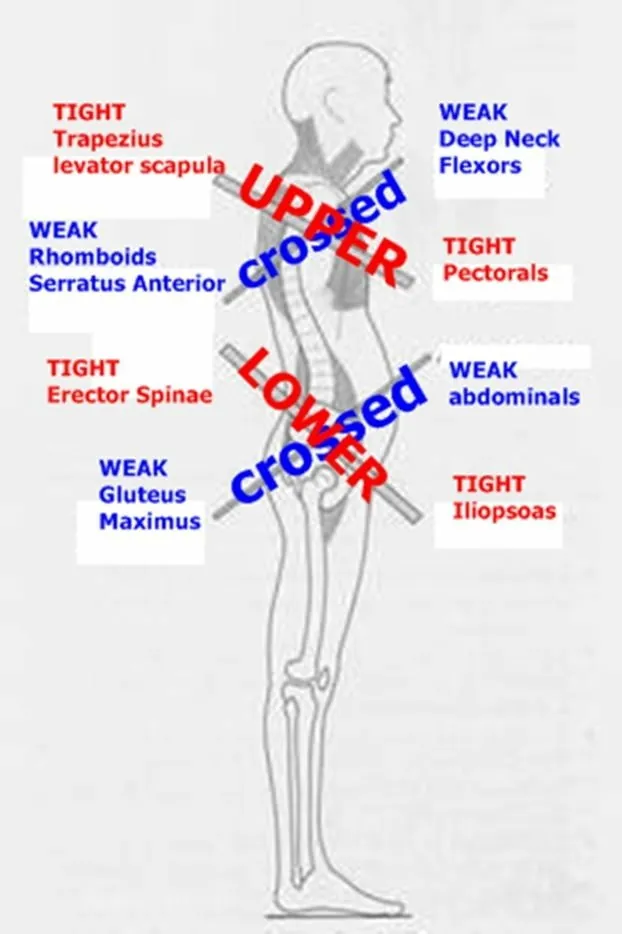 Upper and lower crossed syndrome: tight and weak muscle pairs through the neck, shoulders, trunk and hips.